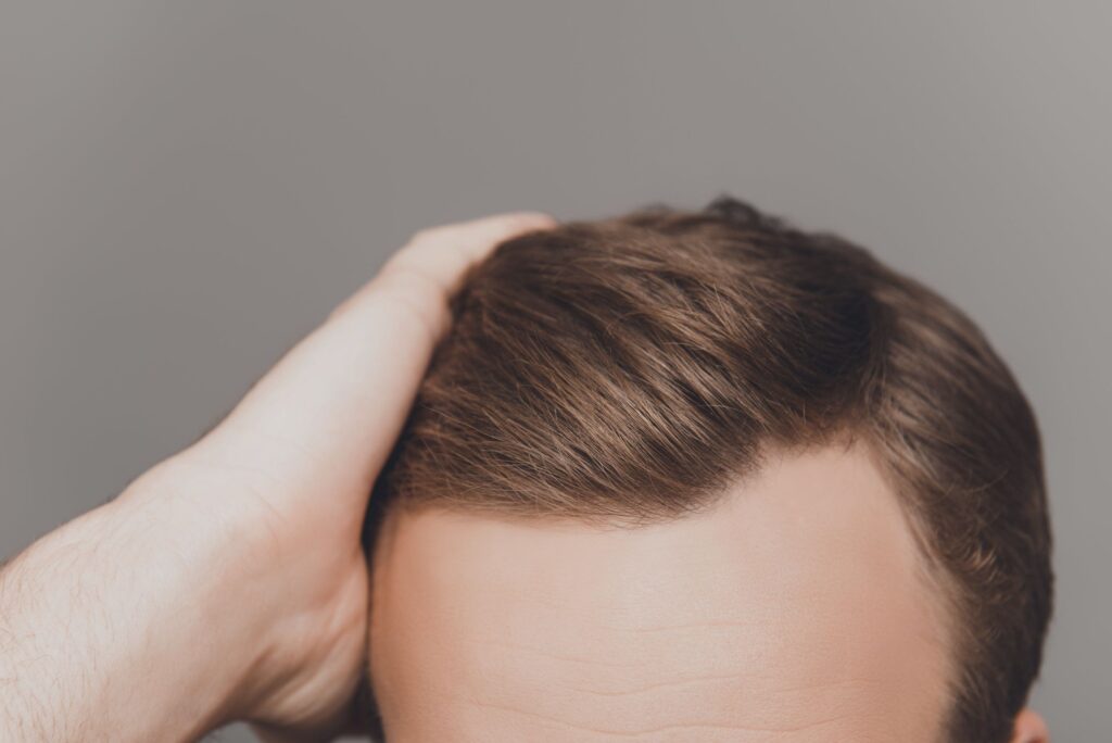 Hair Replacement in Dubai