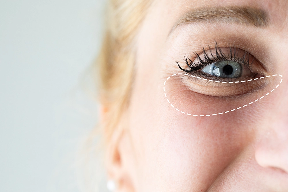 Eye Bag Removal