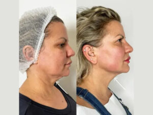 Endolift Treatments in Dubai for Personalized Facial Rejuvenation