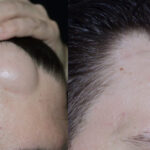 Lipoma Treatment