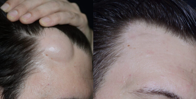 Lipoma Treatment