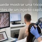 Qué puede mostrar una tricoscopia antes de un injerto capilar