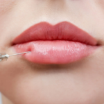 Russian Lip Fillers for a Modern Look