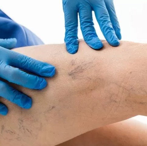 Sclerotherapy In Dubai