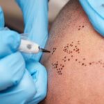 Scalp Micropigmentation Dubai