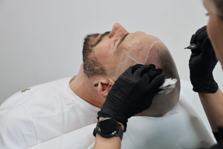 Scalp Micropigmentation