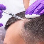 Hair Transplant in Dubai