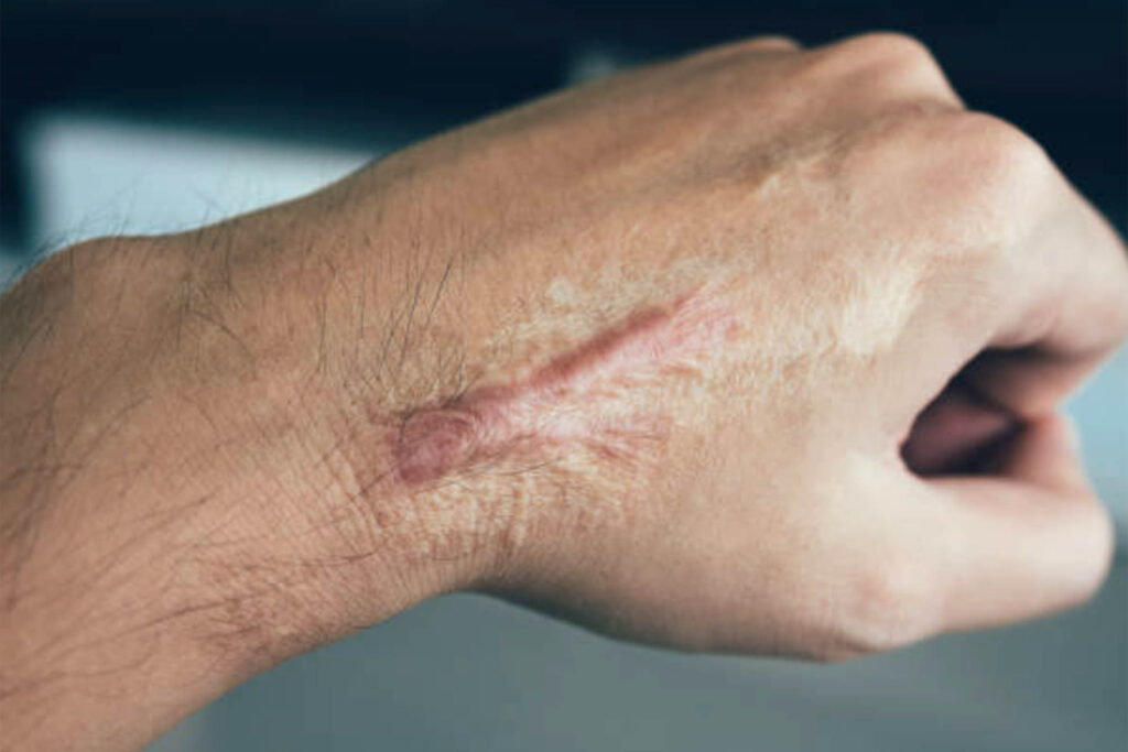 Surgical Scar Revision