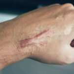 Surgical Scar Revision