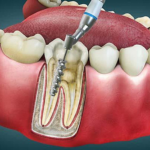 The Life-Saving Benefits of a Root Canal Treatment Explained Simply and Their Importance for Oral Health