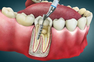 The Life-Saving Benefits of a Root Canal Treatment Explained Simply and Their Importance for Oral Health