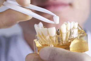 Replace Missing Teeth with an Implant Dentist in Cantonment, FL