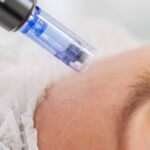 How Does Microneedling Treatment Reduce Scars