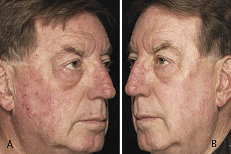 Natural Treatments for Actinic Keratosis and gentle skincare for sun-damaged skin