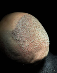 How long does DHI Hair Transplant recovery usually take