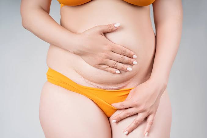 Top 5 Reasons to Consider Our Clinic for a Mommy Makeover