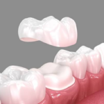 Transform Your Dental Health with Crowns and Restorative Care and Steps in the Dental Crown Procedure