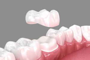 Transform Your Dental Health with Crowns and Restorative Care and Steps in the Dental Crown Procedure