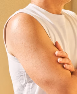Keratosis Pilaris Supplements vs Topical Treatments: Understanding the Differences