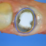 Same Day Crowns in Wiggins, MS: Restore Your Tooth in a Single Visit