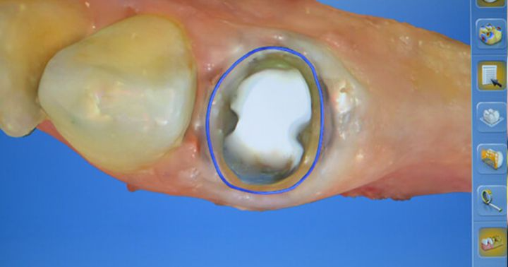 Same Day Crowns in Wiggins, MS: Restore Your Tooth in a Single Visit