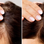 Before And After Hair Loss Treatment