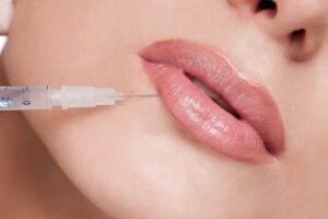 Botox Lip Flip in Dubai