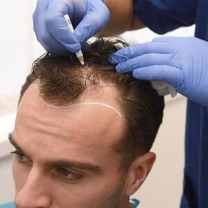 hair transplant in dubai