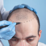 Hair Transplant in Dubai